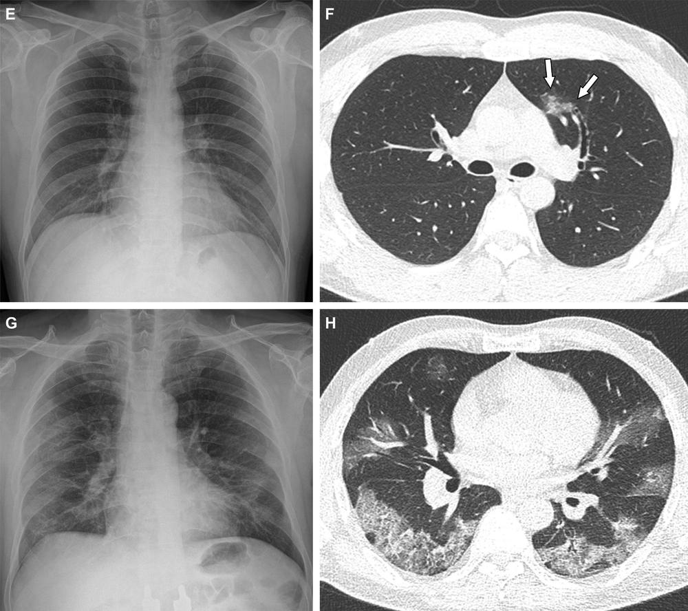 Study Finds COVID 19 Less Severe in Fully Vaccinated Imaging